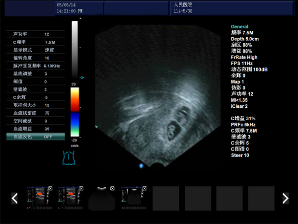 無痛人流機(jī),無痛人流做的時機(jī)