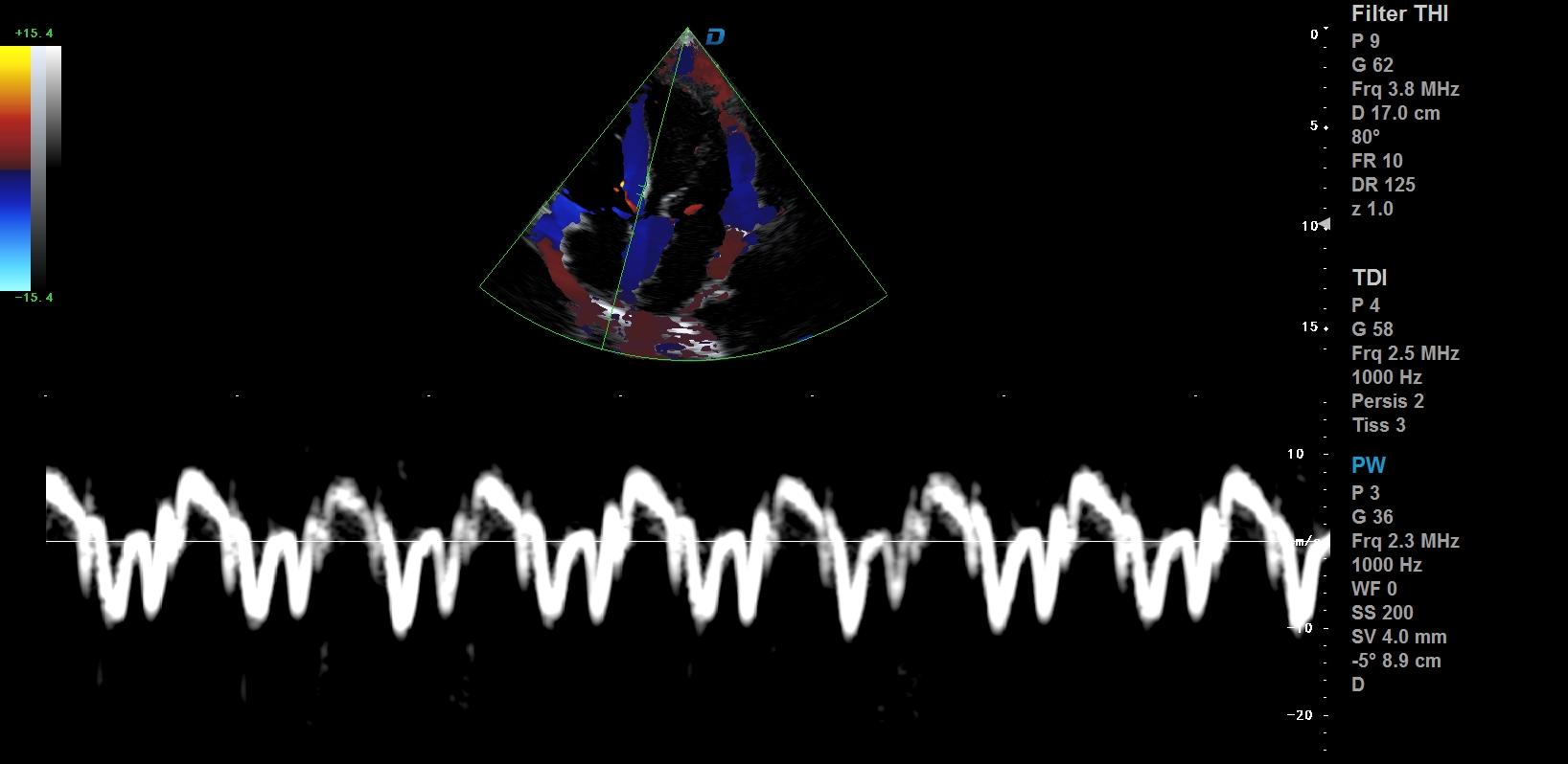 心臟彩超機和超聲心動圖的區別？